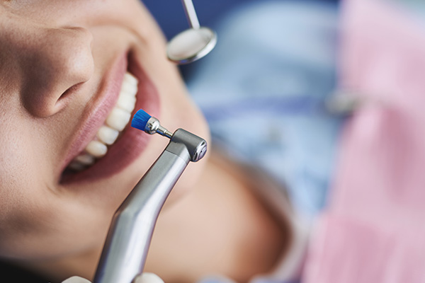 歯面清掃（クリーニング）・表面処理